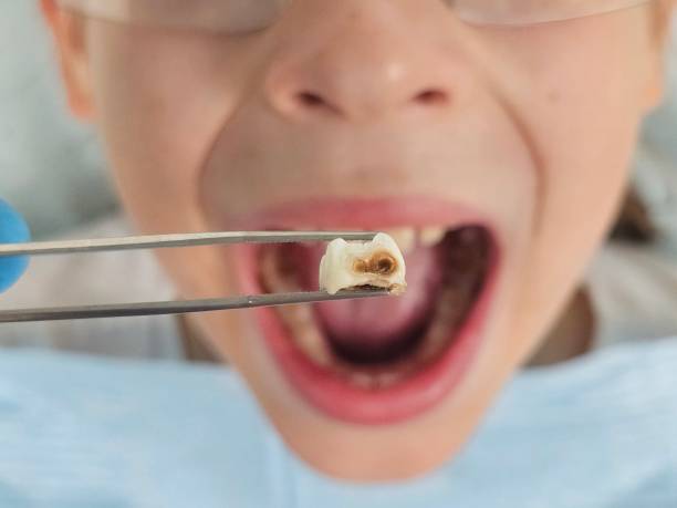 Best Emergency Wisdom Teeth Removal in Whitesboro, NJ